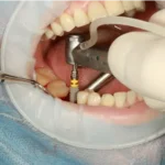 Checklist for Post-Dental Implant Care Ensuring Long-Term Success