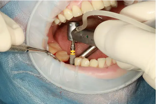 Checklist for Post-Dental Implant Care Ensuring Long-Term Success
